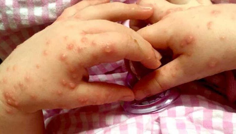 Virus Coxsackie